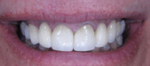 Image of a smile with teeth